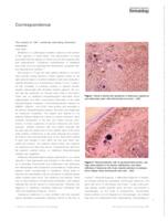 prikaz prve stranice dokumenta The mystery of “4M”: metallosis mimicking melanoma metastasis